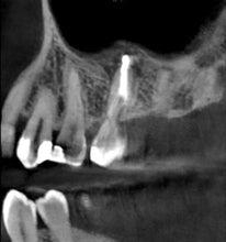 Load image into Gallery viewer, One-Fil PT - Bioceramic Putty 1g