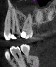 Load image into Gallery viewer, One-Fil PT - Bioceramic Putty 1g