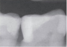 Load image into Gallery viewer, Rhondium DME Wedges - Assorted, 100 pack