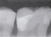 Load image into Gallery viewer, Rhondium DME Wedges - Assorted, 100 pack