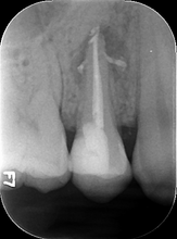 Load image into Gallery viewer, One-Fil Bioceramic Sealer