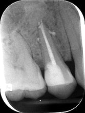 Load image into Gallery viewer, One-Fil Bioceramic Sealer