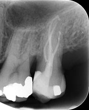 Load image into Gallery viewer, One-Fil Bioceramic Sealer