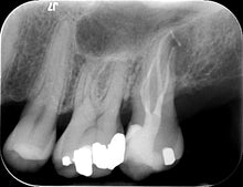 Load image into Gallery viewer, One-Fil Bioceramic Sealer