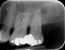 Load image into Gallery viewer, One-Fil Bioceramic Sealer