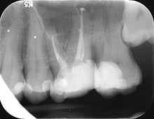 Load image into Gallery viewer, One-Fil Bioceramic Sealer