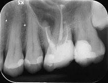 Load image into Gallery viewer, One-Fil Bioceramic Sealer