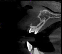 Load image into Gallery viewer, One-Fil PT - Bioceramic Putty 1g