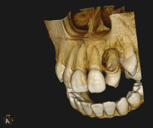 Load image into Gallery viewer, One-Fil PT - Bioceramic Putty 1g