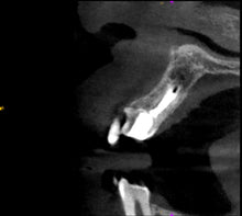 Load image into Gallery viewer, One-Fil PT - Bioceramic Putty 1g