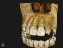 Load image into Gallery viewer, One-Fil PT - Bioceramic Putty 1g