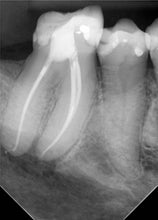 Load image into Gallery viewer, One-Fil Bioceramic Sealer