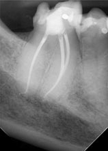 Load image into Gallery viewer, One-Fil Bioceramic Sealer